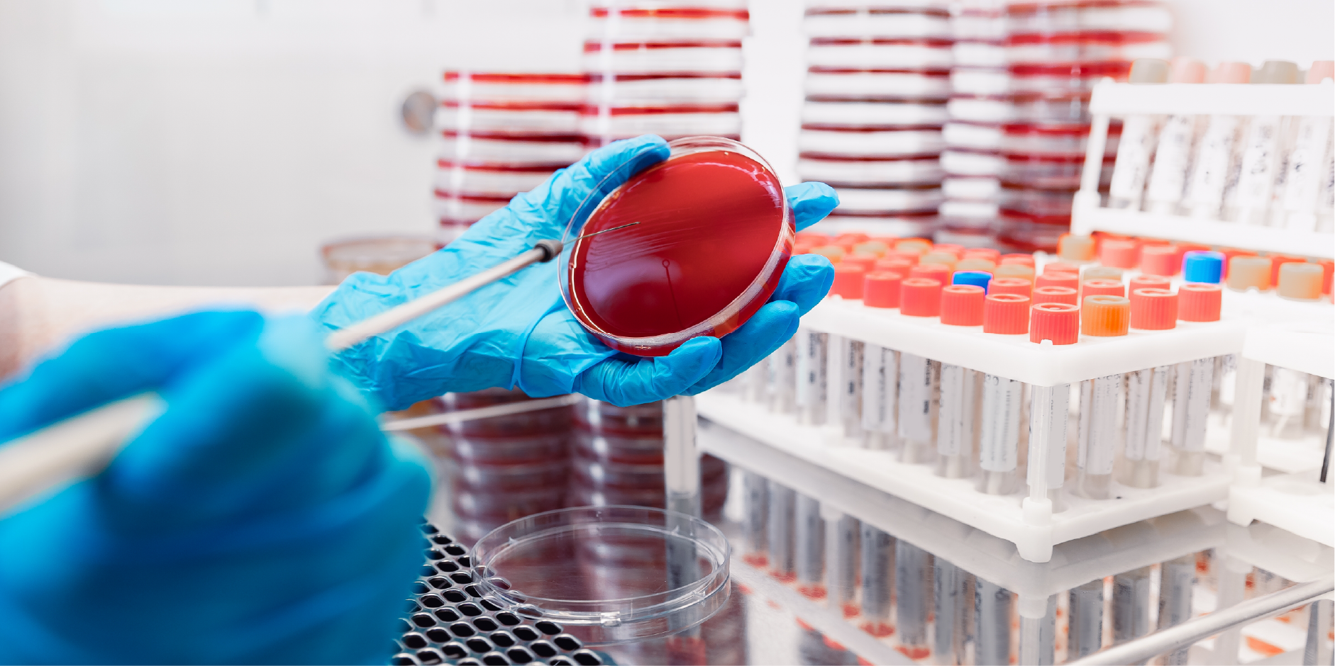 Pneumonia - Hospital-Acquired : Diagnostics | MIMS Singapore