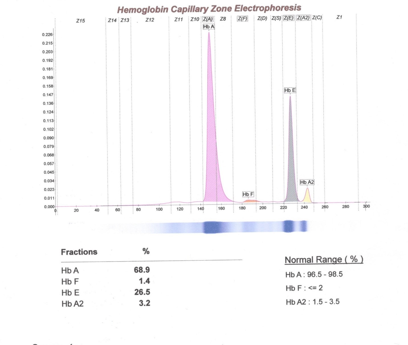 Hemoglobin electrophoresis report of the patient shows increased in HbH...  | Download Scientific Diagram