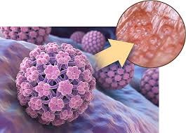 Cervical Cancer Causes, Signs and Symptoms, and Stages | Saint John's  Cancer Institute - Santa Monica, CA