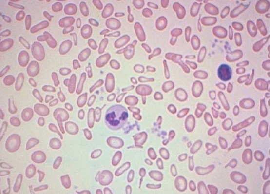 Microcytic  Hypochromic Anemia smear